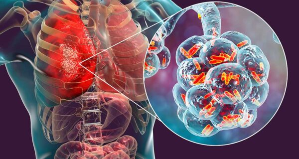 Legionella Awareness